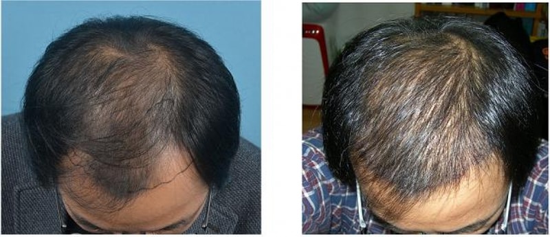 수술 전후 사진(7일째).jpg