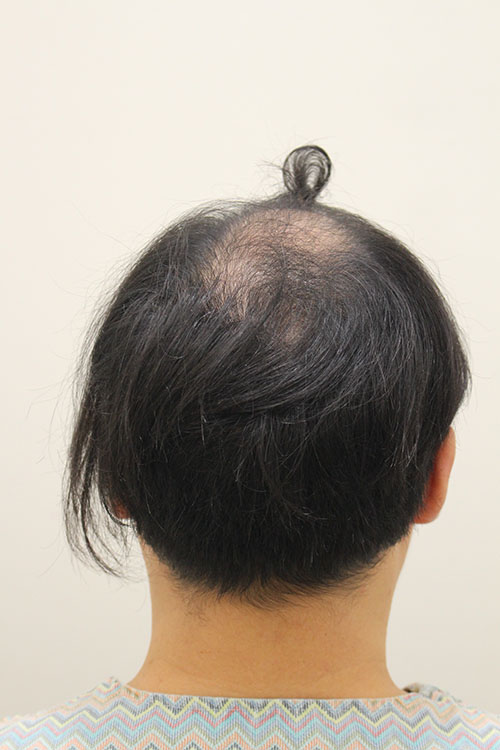 모앤블레스에서 수술한지 7개월 좀 넘었는데 자연스럽지 않나요?