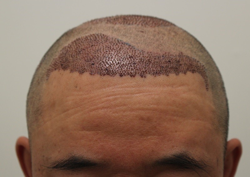 3.수술1일째.jpg