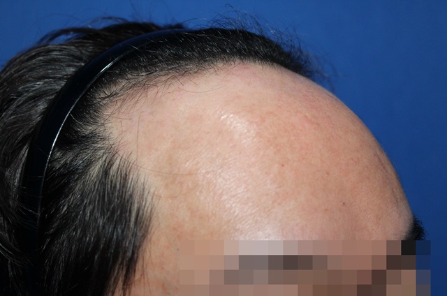 깊은 M자 탈모 3700모 이식한지 벌써 11개월 지났네요