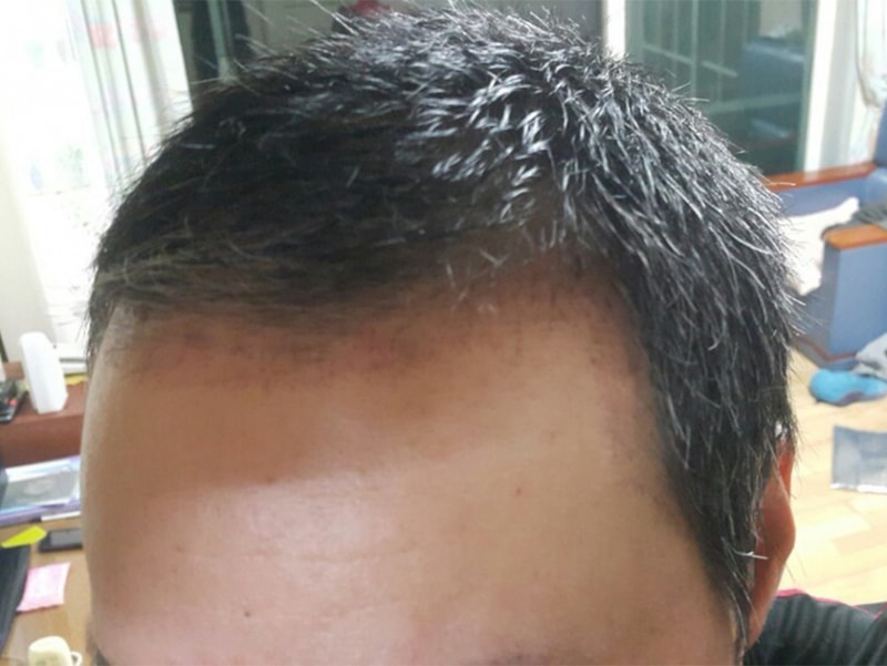 6.수술3개월후.jpg