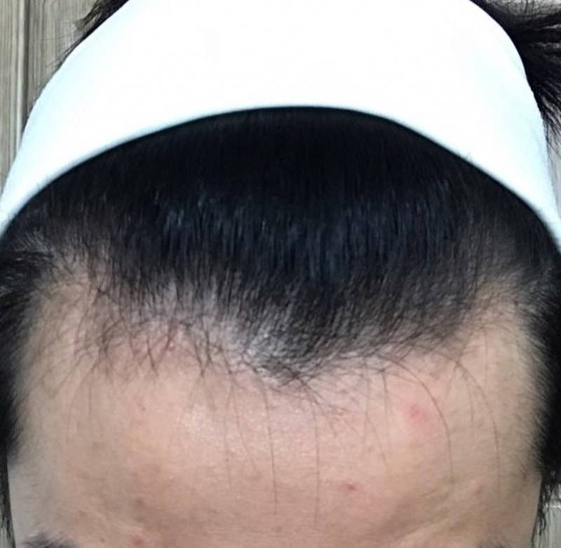 수술 전 M자.jpg