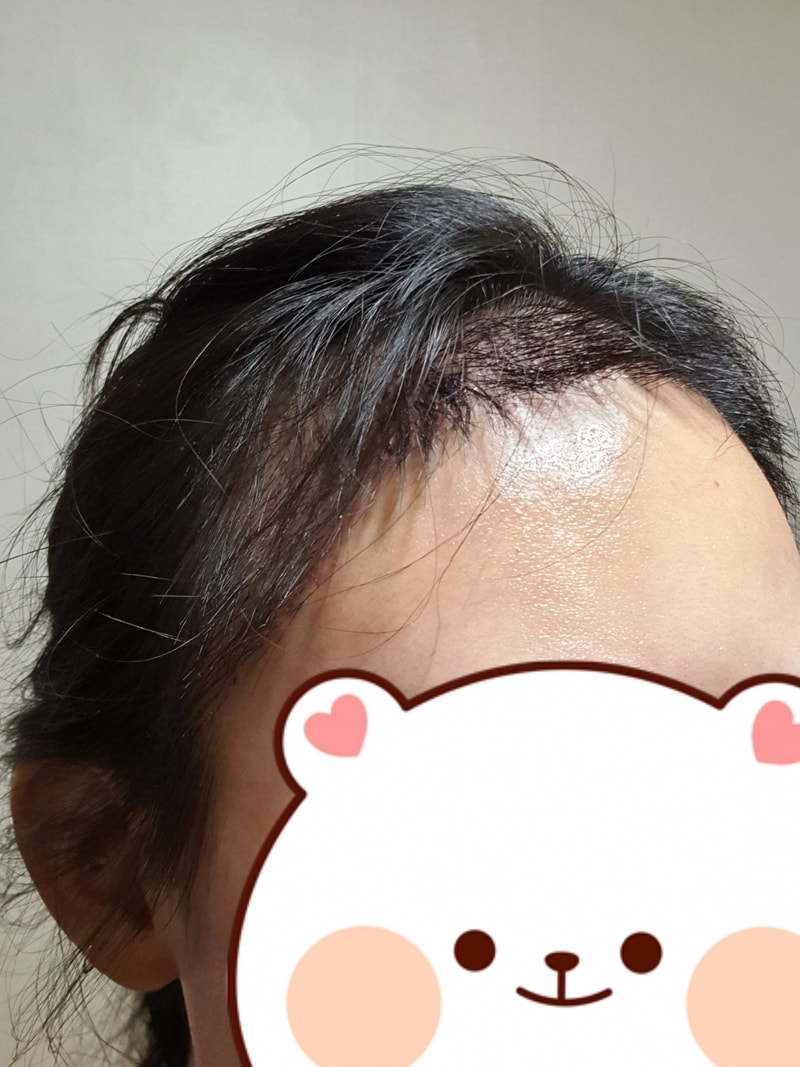 수술3일차_1.jpg