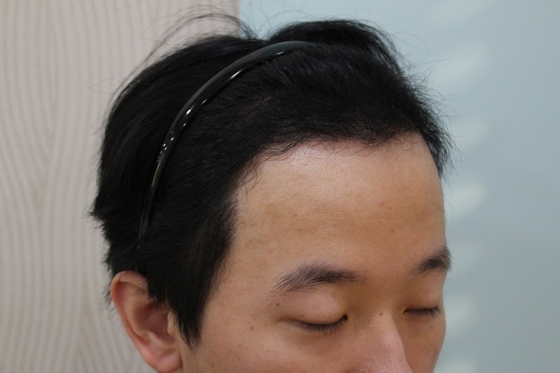 수술후 5개월 (1).jpg