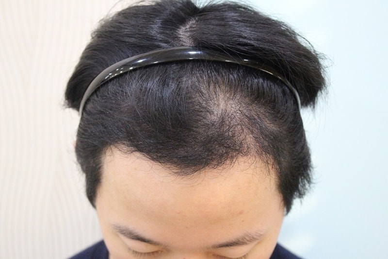 수술후 5개월 (4).jpg