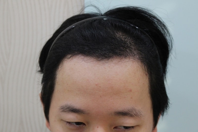 수술후 5개월 (3).jpg