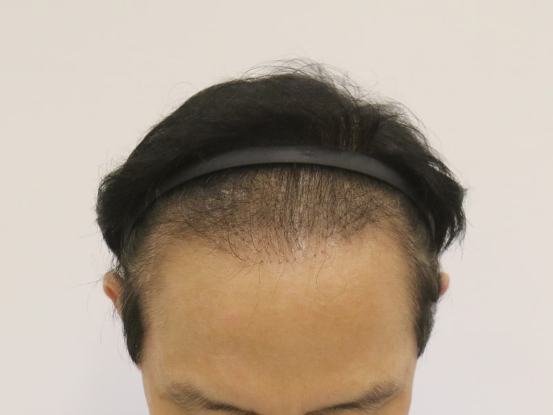 Mammoth Hairline Non-Cutting Slit Reoperation Day Review