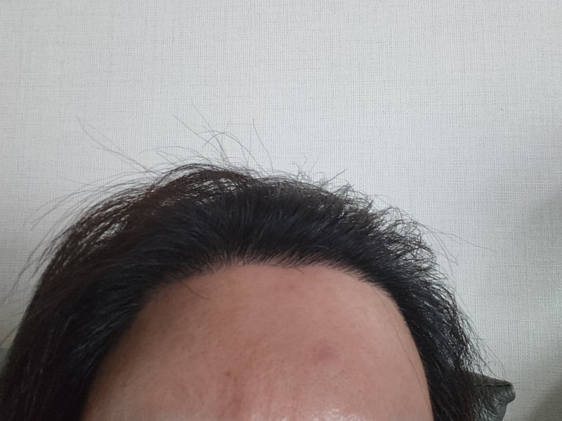 광주 압구정모비앙에서 수술한지 10개월됐어요