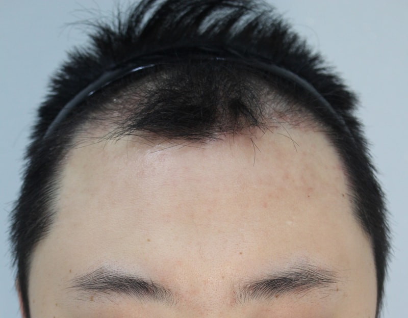 수술3개월.jpg