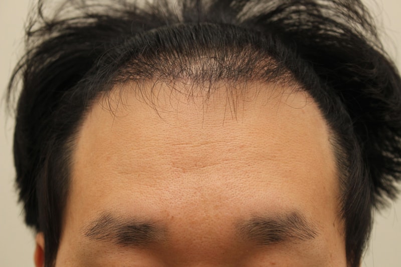 이식5개월째앞.jpg