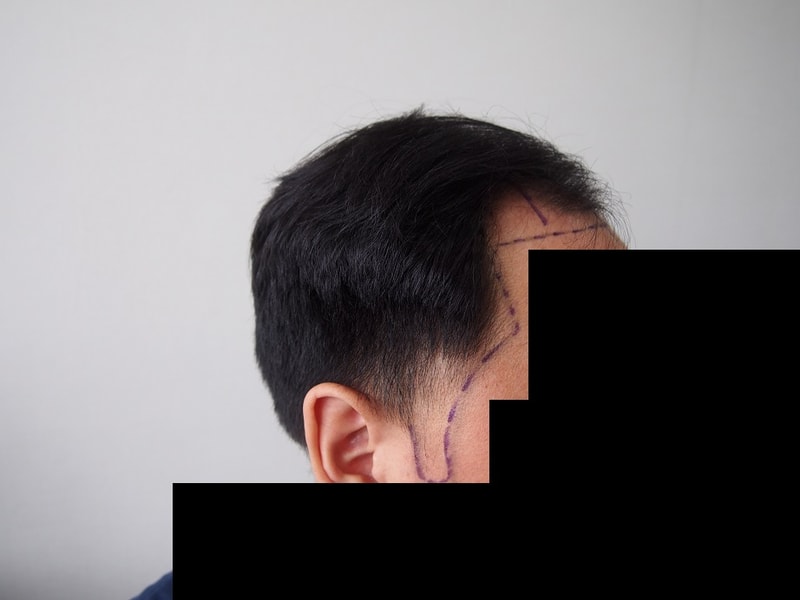 03. 수술전 측면.JPG