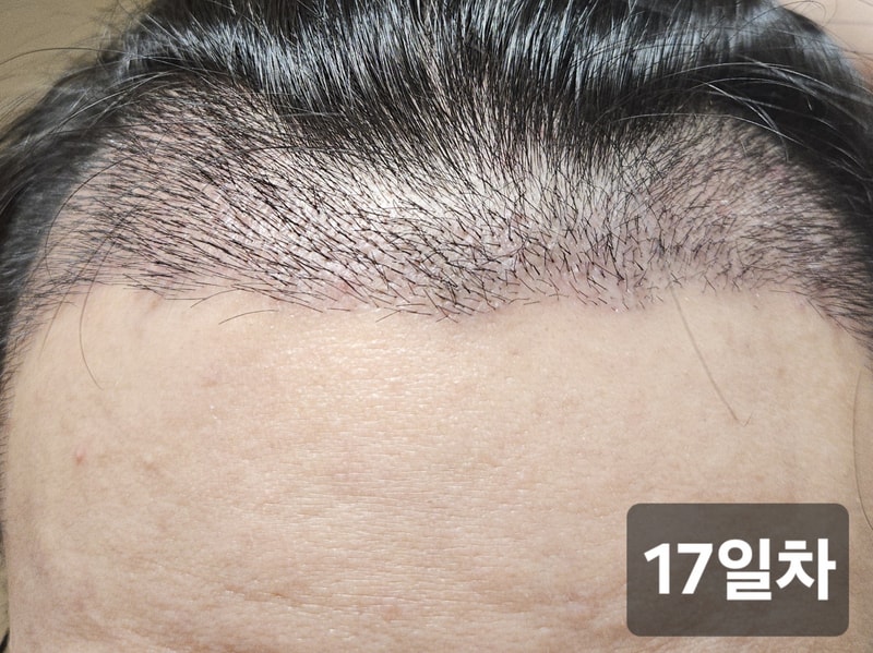 [노블라인 모발이식센터] 수술 17일차 후기입니다.