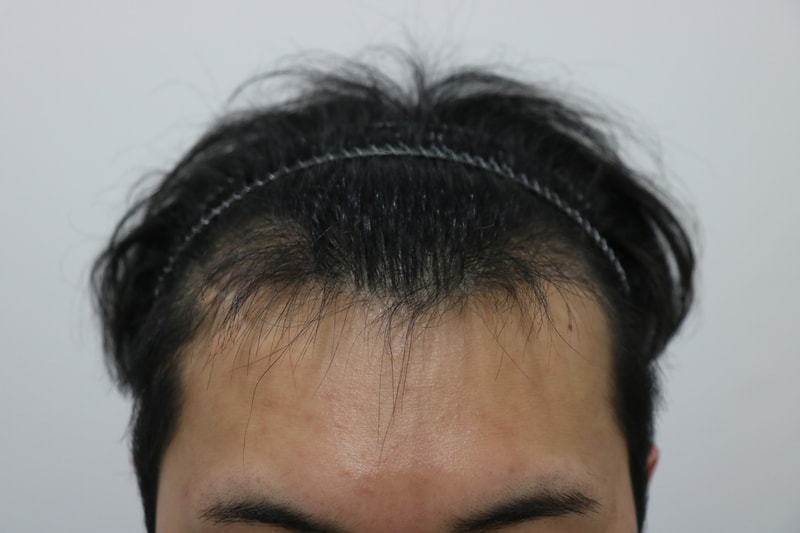 수술3개월차1.jpg