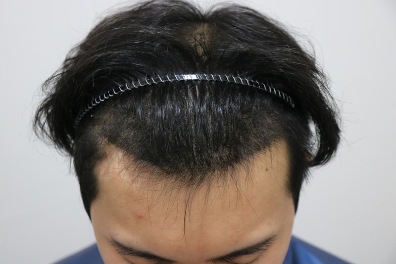 2주경과사진4.jpg