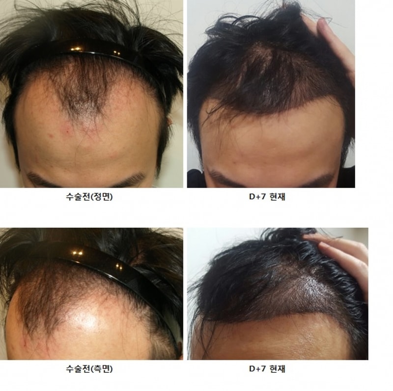 D+7 수술 전후 사진.jpg