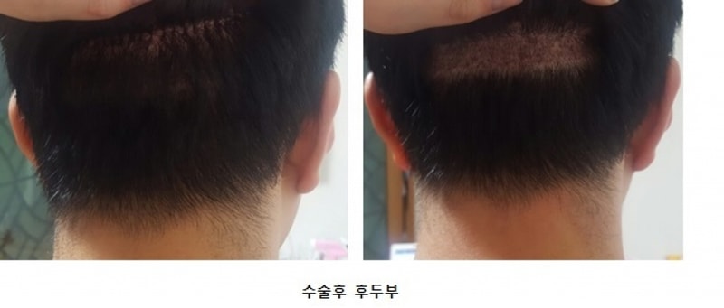 수술후 후두부.jpg