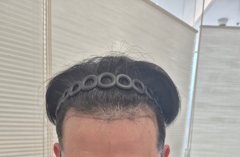 모엠의원 비절개 270일차 후기