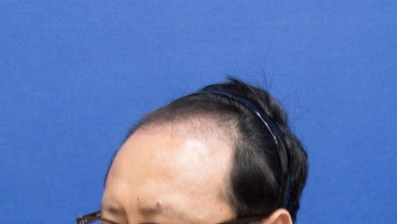 수술후 3개월2.jpg