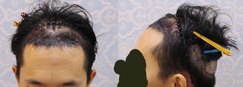 김준서_수술후_20150302.jpg