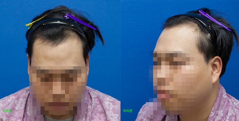 수술전.jpg