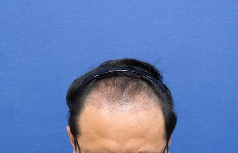 수술후 3개월.jpg