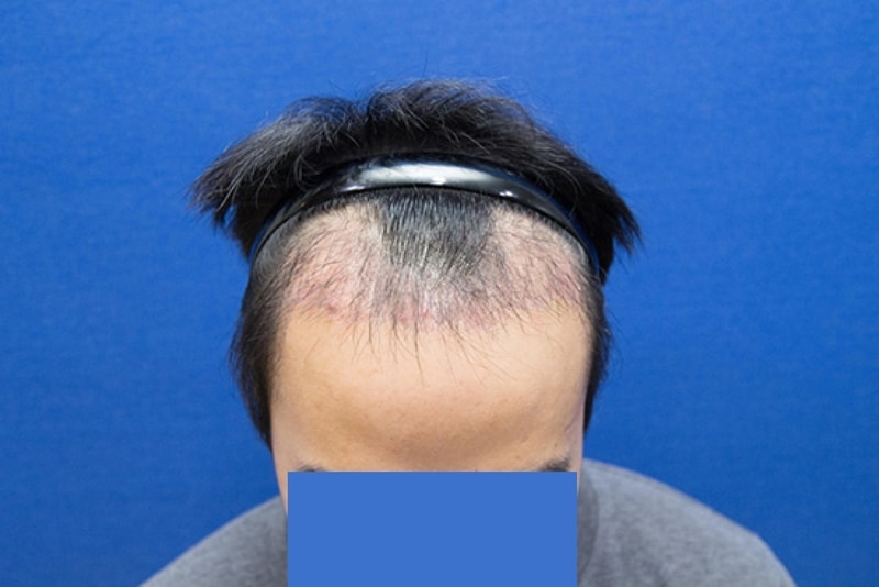 수술 한달후.jpg