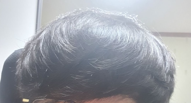 수술 후 앞머리 내렸을때.jpg