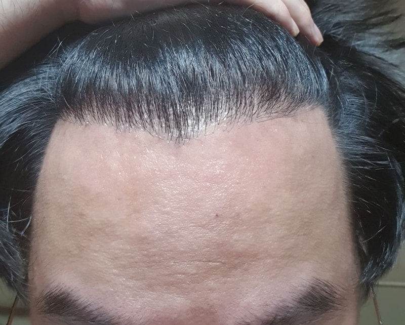수술 후 앞머리 올렸을때.jpg