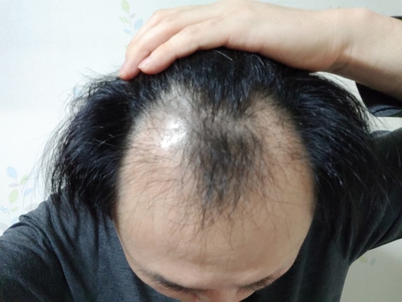 절개식 모발이식 하고 왔습니다