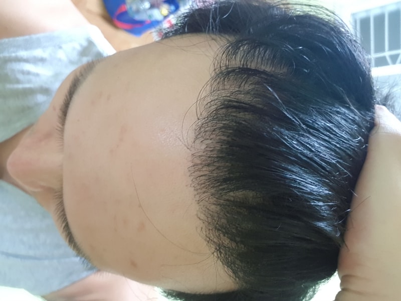1차수술후 2차수술 9개월차 모션 밀도보강 재수술 입니다!
