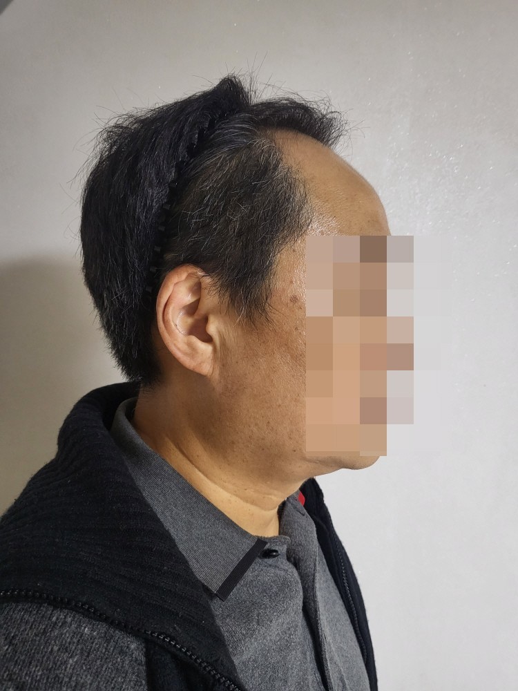 꾸미기20231023_문성용_수술전.jpg
