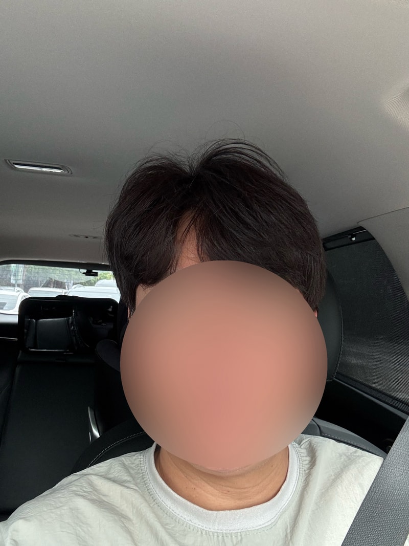 모발이식7년 후기입니당~