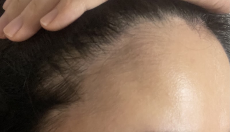 모디헤어플란트 여성헤어라인 6개월차 후기