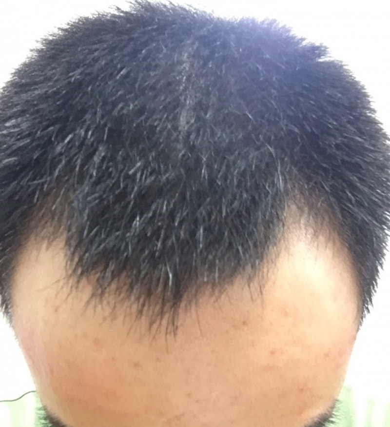 이식전이발후 위에서.jpg