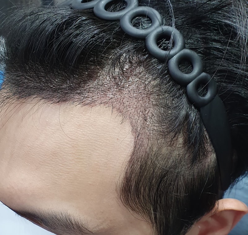 수술_후_왼쪽.jpg