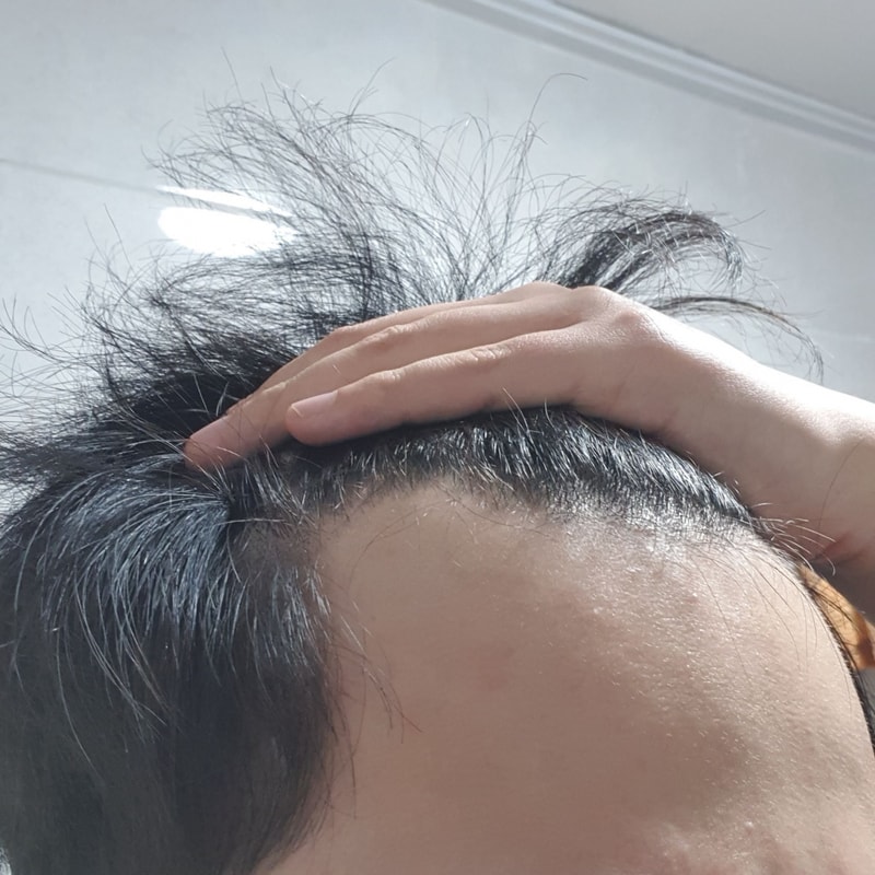 수술전 왼쪽.jpg
