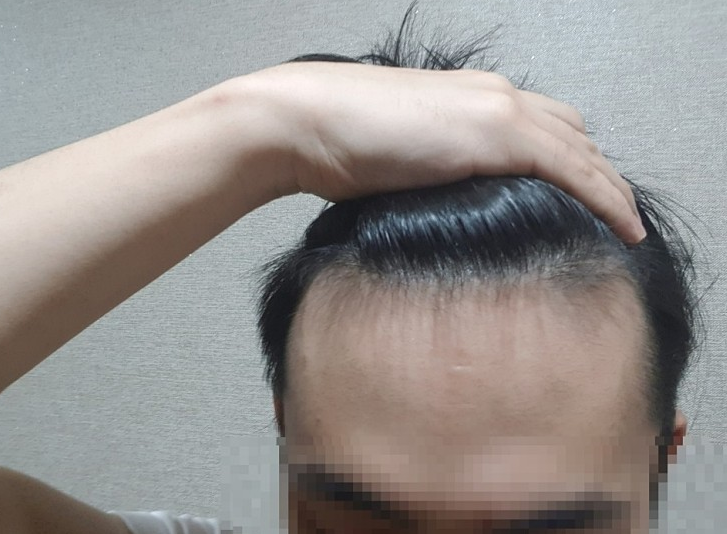 비포33.PNG
