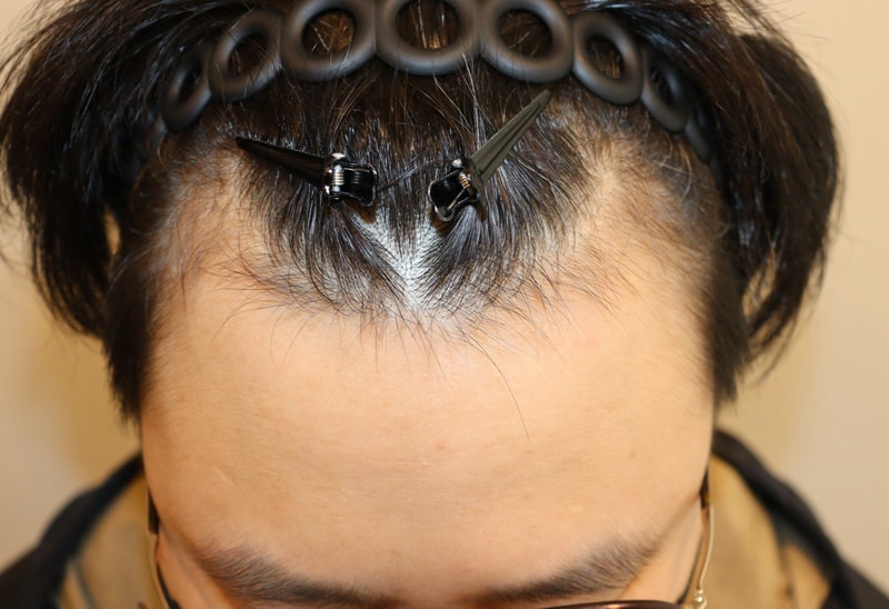 It is a six-month review of Daegu Apgujeong Mobiang nasotomy.
