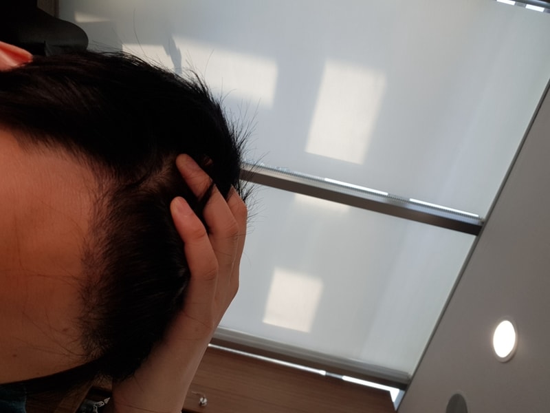 모재성 2차 추가 1050모냥 비절개 4개월차 사진입니다!