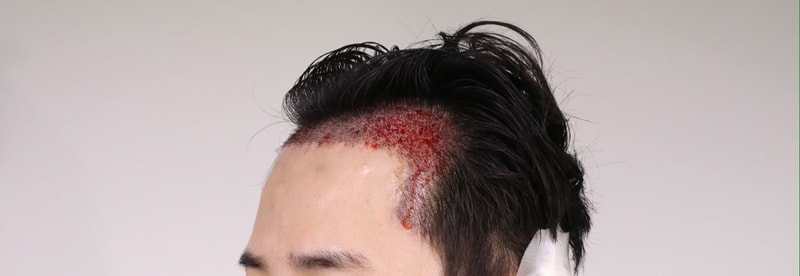 모발이식.jpg