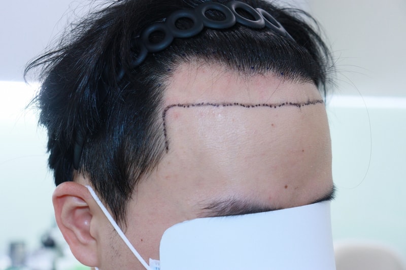 광주 압구정모비앙 모발이식 10개월 후기