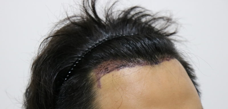 수술후 3.jpg
