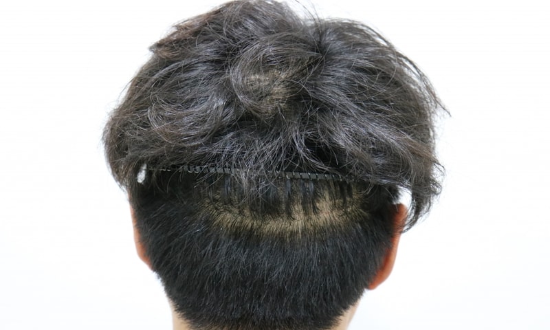 수술후 2주후 3.jpg