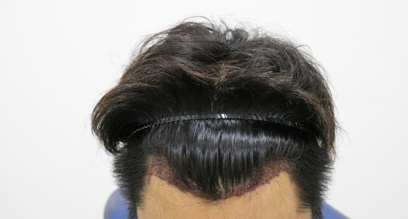 수술후 1.jpg