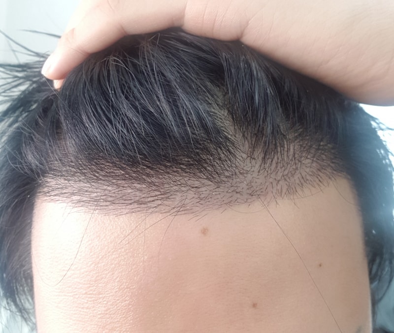 모재성 1080모낭 리터치겸 재수술!