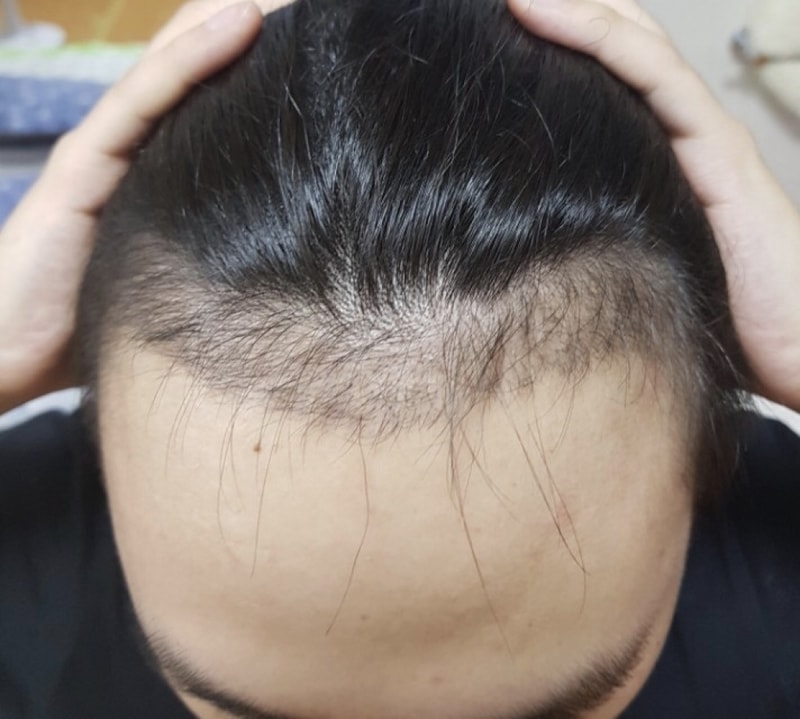 비절개 86일차 경과사진입니다