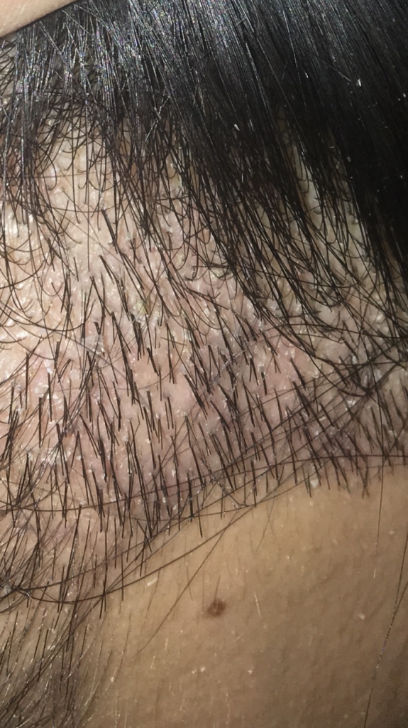 This is the exfoliation review for the 2nd evaluation of the forehair