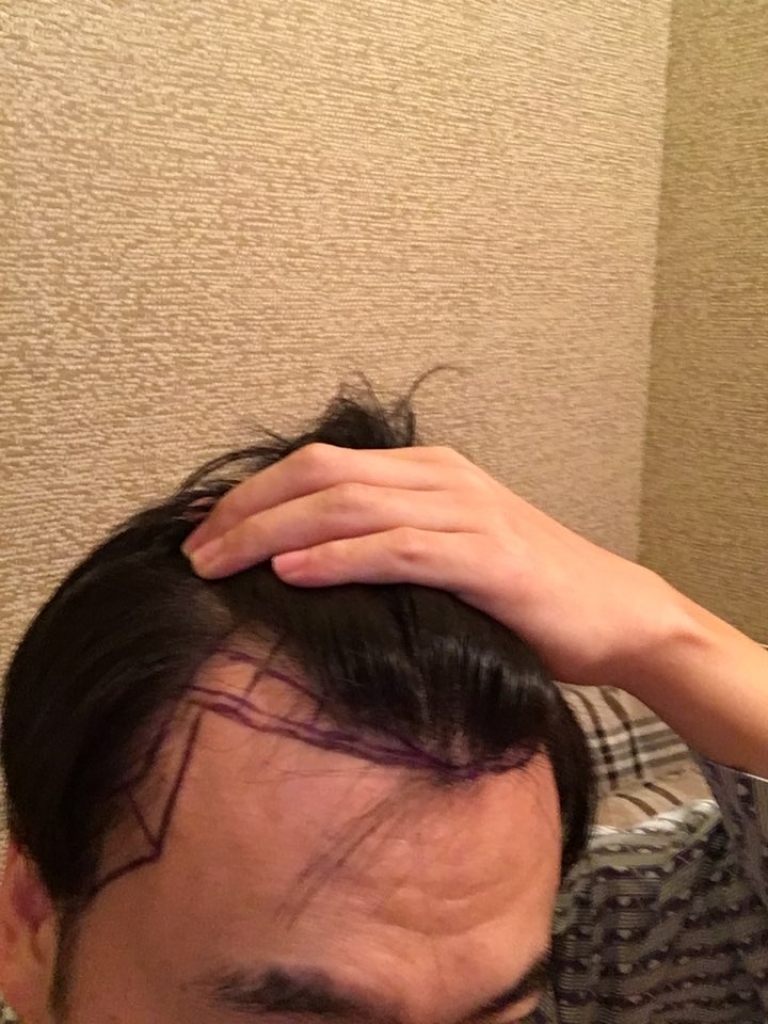 절개 이식 하였습니다.