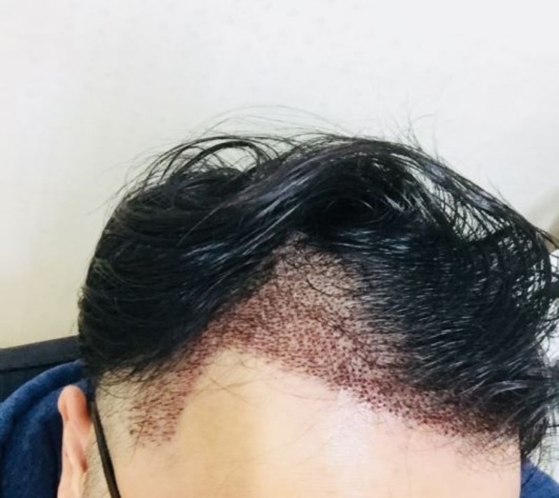 수술4일차.JPG