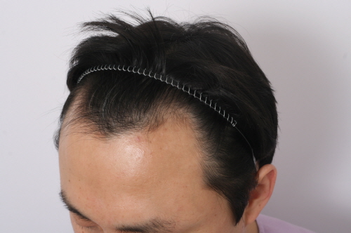 수술전 (3).jpg